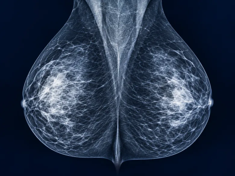 Illustrative mammography image; not a sample from this source