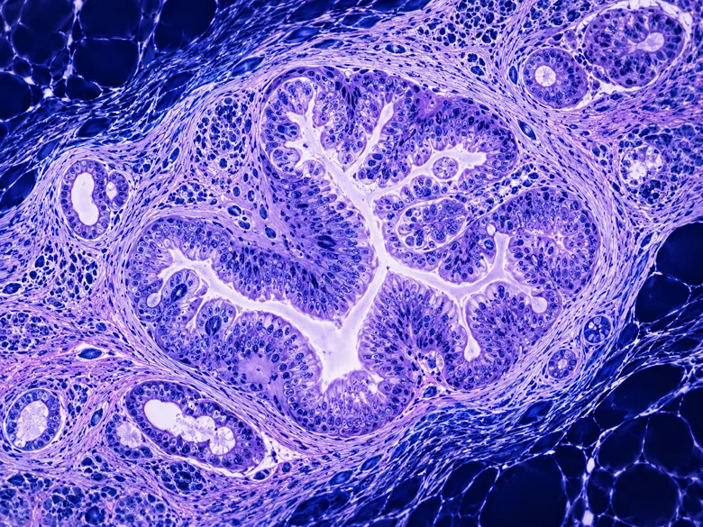Illustrative oncology and pathology artwork; not an image from this dataset